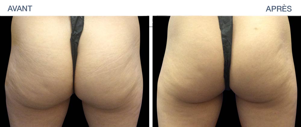 Before - after : build muscle in the buttocks with EMSculpt