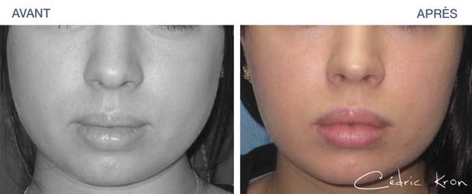Avant - Après d'une réduction de la mâchoire par injection de botox sur une femme de 25 ans