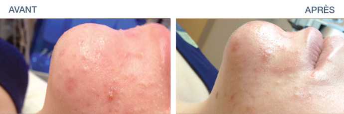 Avant - Après : Résultat d'HydraFacial sur une peau grasse