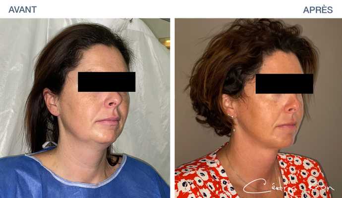 Avant-après : Lipoaspiration de l'ovale visage