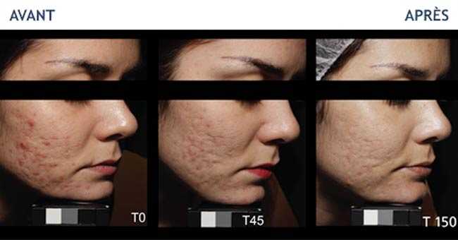 Avant - Après Universkin : Traitement des cicatrices d'acné