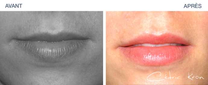 Photo avant - Après d'un traitement esthétique des lèvres par acide hyaluronique