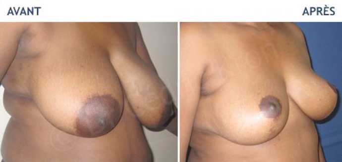 Avant - Après d'une chirurgie esthétique de réduction mammaire
