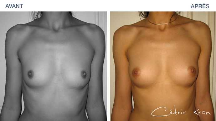 Before-After : breast lipofilling after a liposuction of the thighs