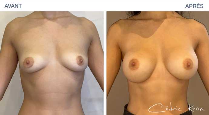 Augmentation mammaire par prothèses à Paris, réalisée par le Dr Kron