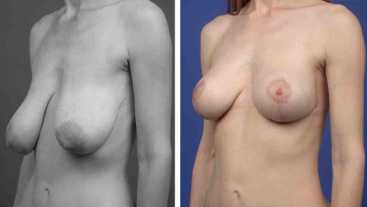 Avant-Après : Correction de ptôse mammaire - Lifting des seins