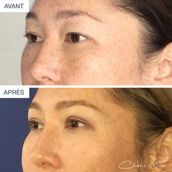 Before & After Asian blepharoplasty