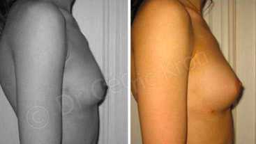 Avant-Après : Lipostructure des seins - Lipofilling mammaire