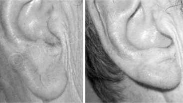 Avant-Après : Réparation chirurgicale des lobes d'oreille