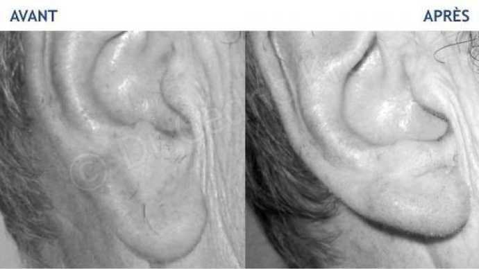 Avant - Après d'une correction chirurgicale des lobes d'oreilles déformées