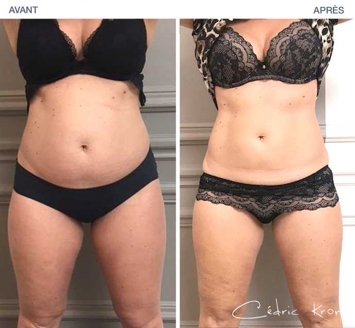 Result of a thinning of the belly treatment using CoolSculpting