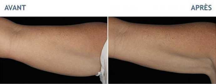 Before & After pictures of Cryolipolyse with Coolsculpting treatment