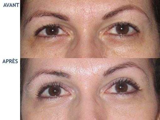 Before and after photo of blepharoplasty