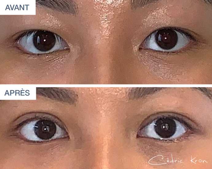 Result of a double-eyelid surgery performed on a 20-year-old woman