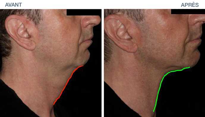 Treatment of cutaneous relaxation of the neck