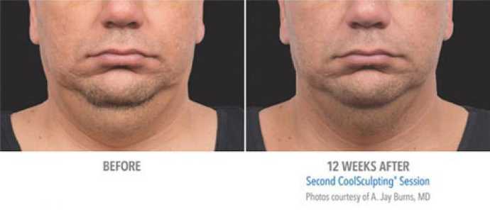 Before - After: removing double chin effect with Coolsculpting cryolipolysis technique